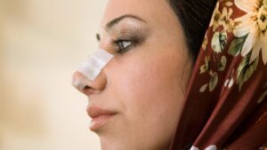 Chirurgie-esthétique-nez-Iran